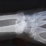 Maladies osseuses