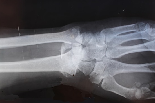 Maladies osseuses